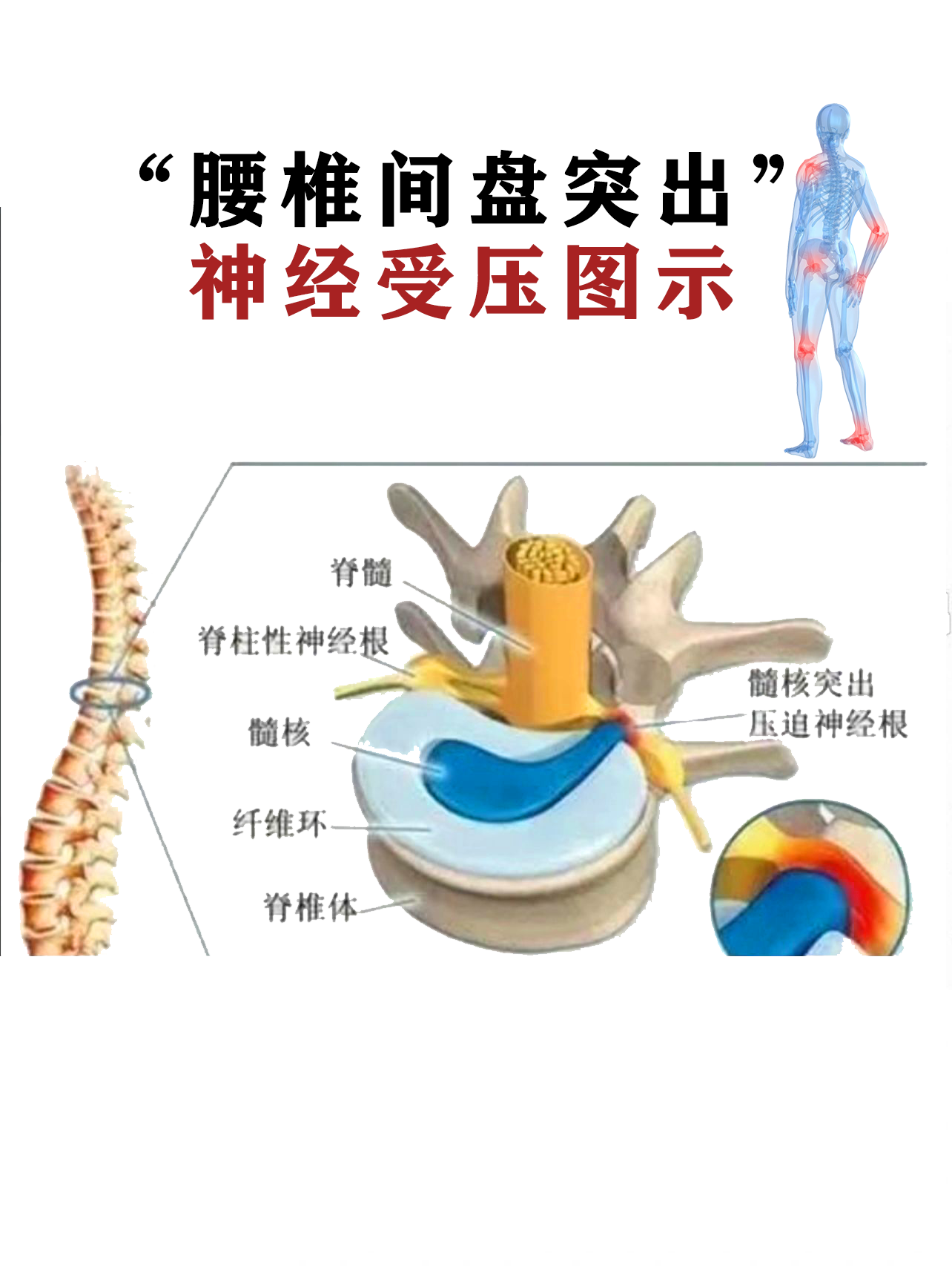 腰椎间盘突出的知识科普