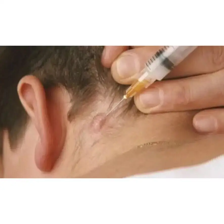 「疤痕软化针」问题的解答