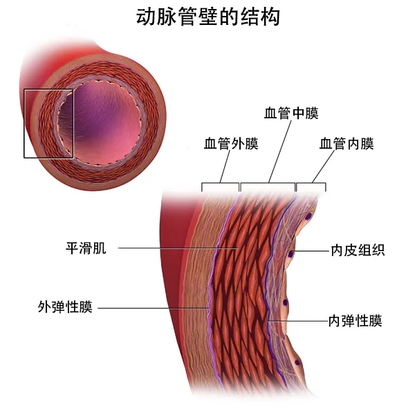 血栓和斑块的区别图片