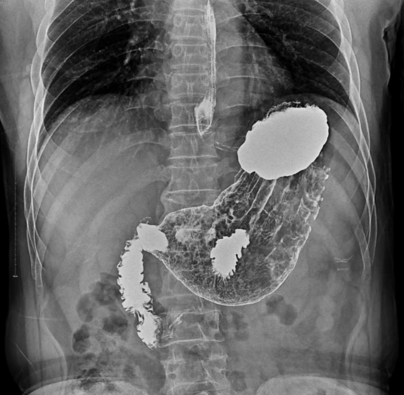 胃食管反流病的相关检查有哪些?