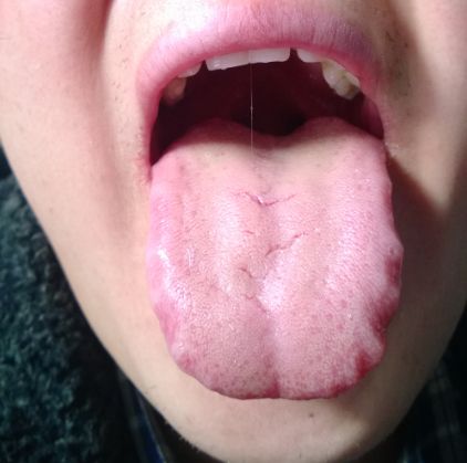 舌头上面有裂纹,还有齿痕,多是胃热脾虚,一个中成药,健脾泻胃