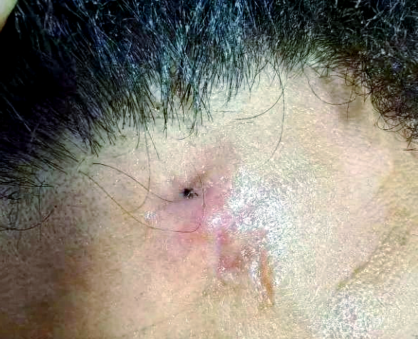 手术线头排异反应的多种可能因素解析