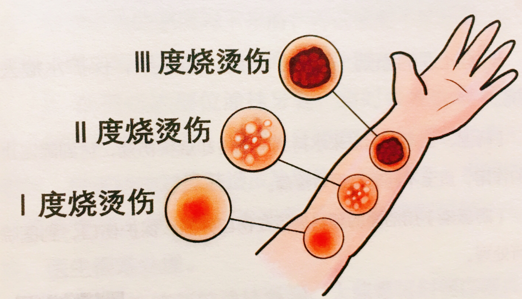 家有认知障碍老人如何避免被烫伤?发生烫伤如何应急处理?