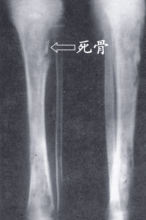 骨科影像诊断详解:关节脱位与感染的110张x线片解读