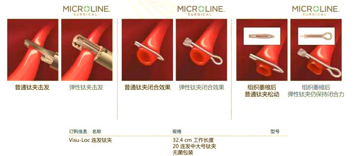 多种优质钛夹——灵活的止血选择