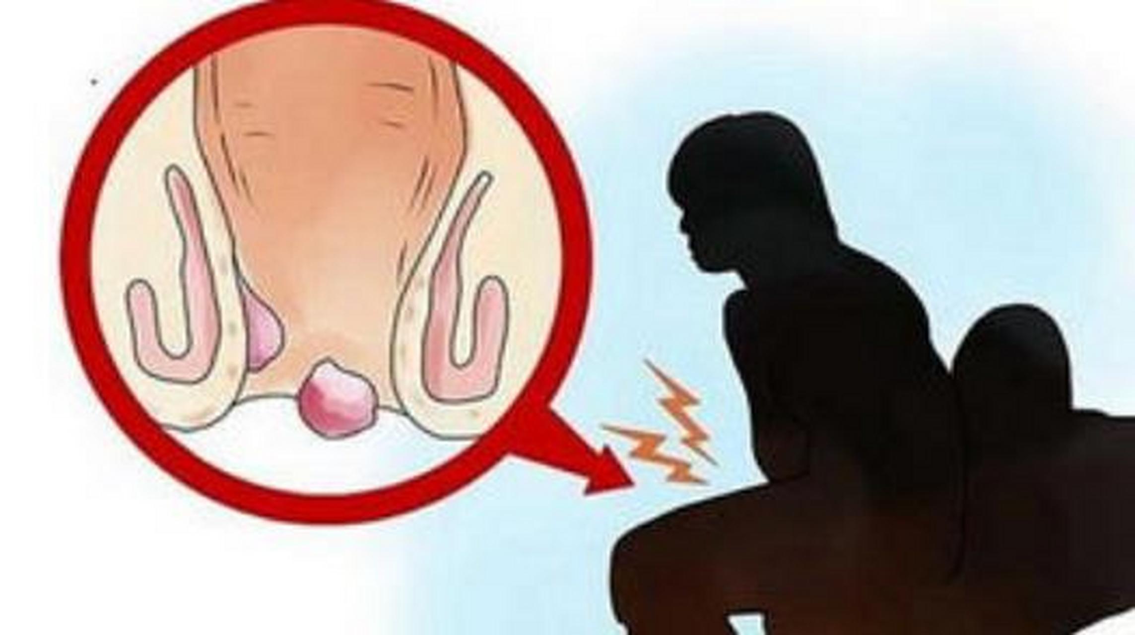 怀孕三个月,上厕所时,一个"肿块"从肛门掉了出来,以为是痔疮,就没在意