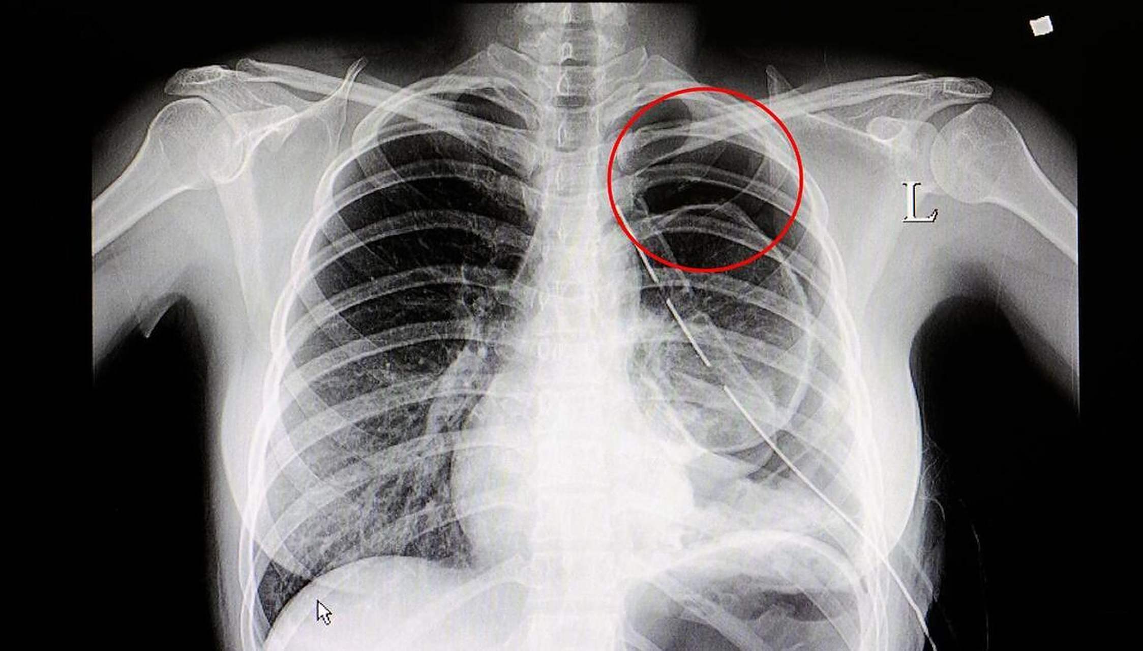 年纪36岁,肺像65岁,不自律的人生,健康损害体现无疑!