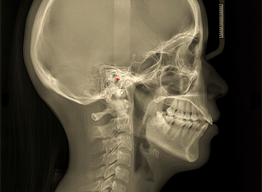 头影测量标志点详解,助你精准诊断