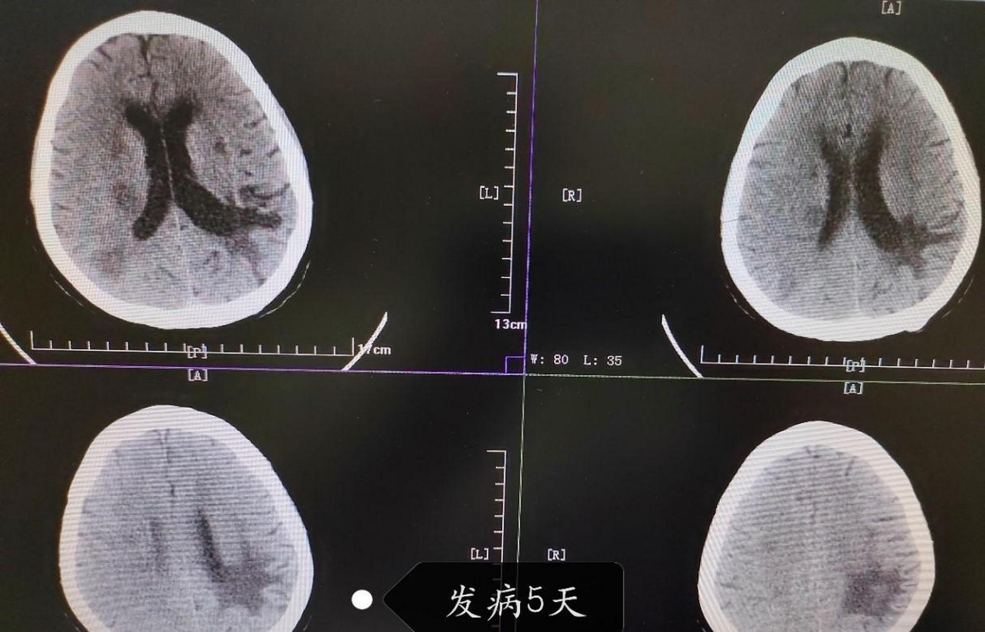 大脑会出现半身不遂,语言障碍,口眼歪斜等症状,这就是脑梗后遗症,也就
