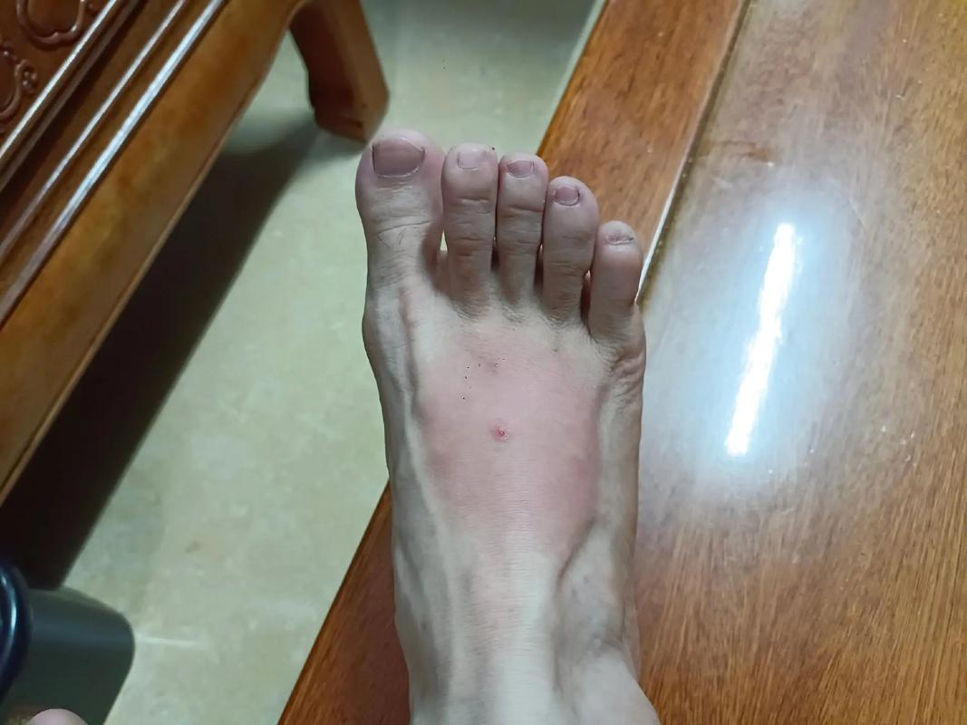家中被黑蚂蚁咬伤引发休克:及时就医的必要性