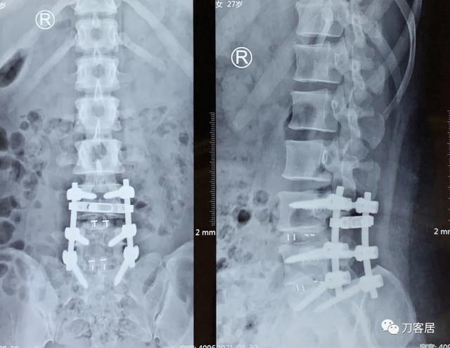 27岁女性,两间隙腰椎间盘突出症,6颗钉子,4个融合器