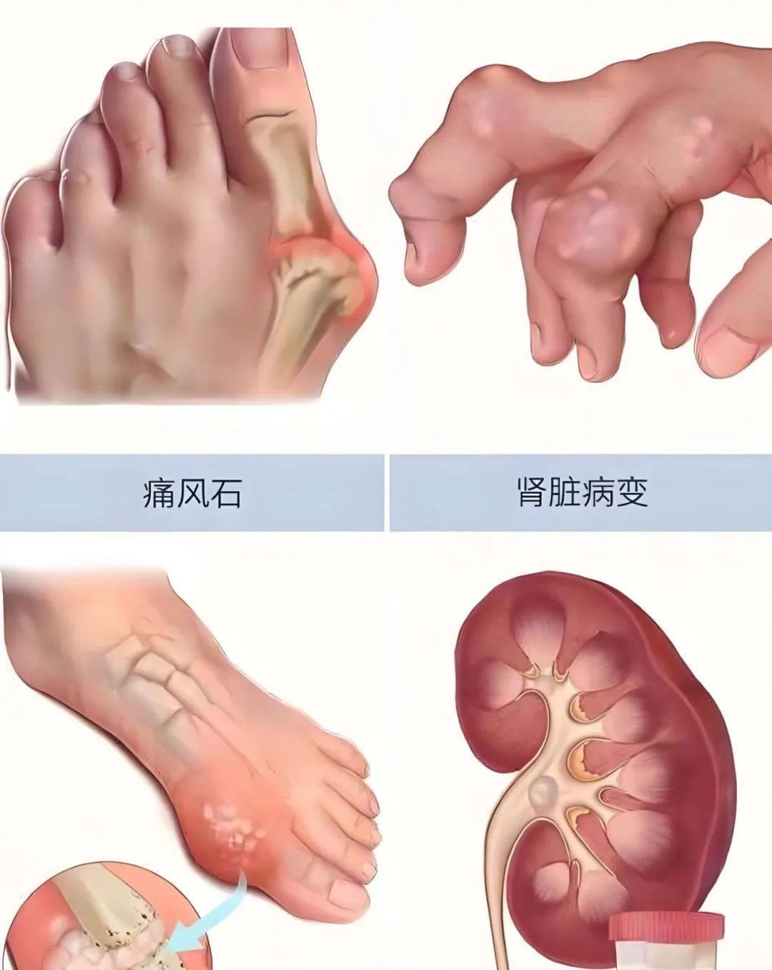 痛风石怎么消除?一项检查一种治疗全解决,痛风专家黄川云解答!