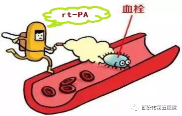 「静脉溶栓」静脉溶栓知多少?