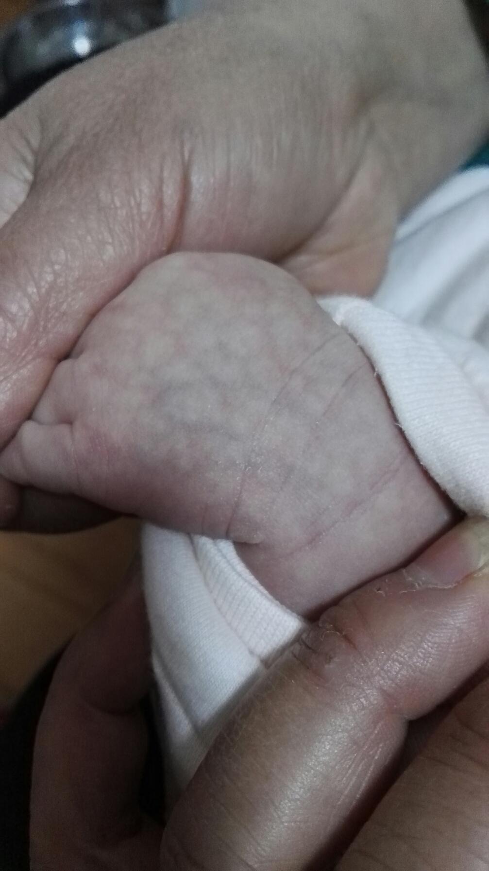 新生儿静脉炎早期图片图片