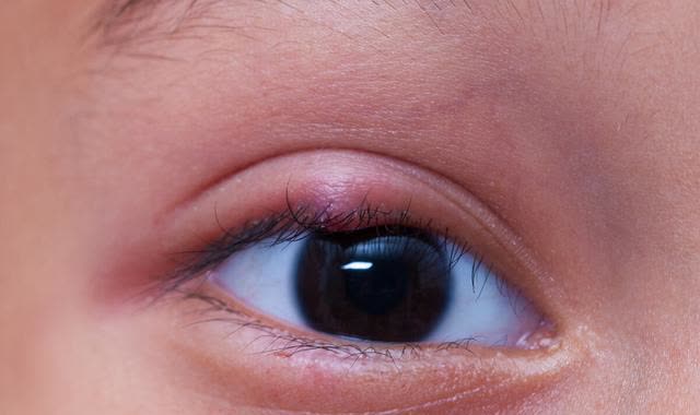 眼皮里长了一个痘,卡眼睛,又肿又痛,怎么回事?