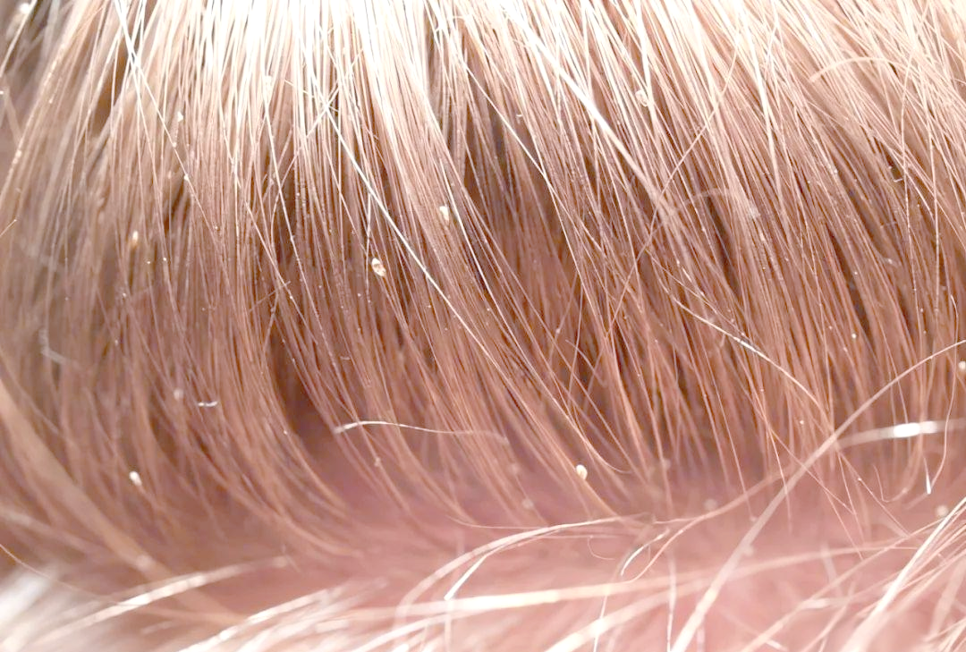 我们常常会在头发上发现一些比芝麻还小的白色颗粒,这些就是虱子