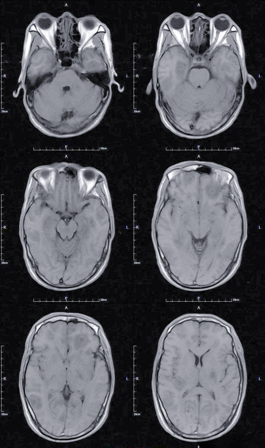 囊虫病:一种常见的中枢神经系统寄生虫感染