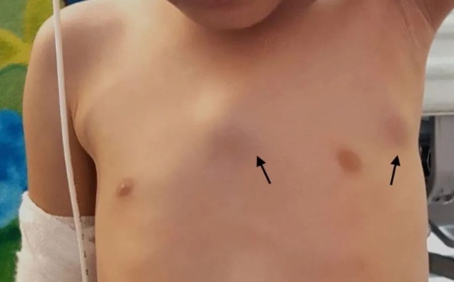 胸壁肿物(胸骨结核,胸壁结核)