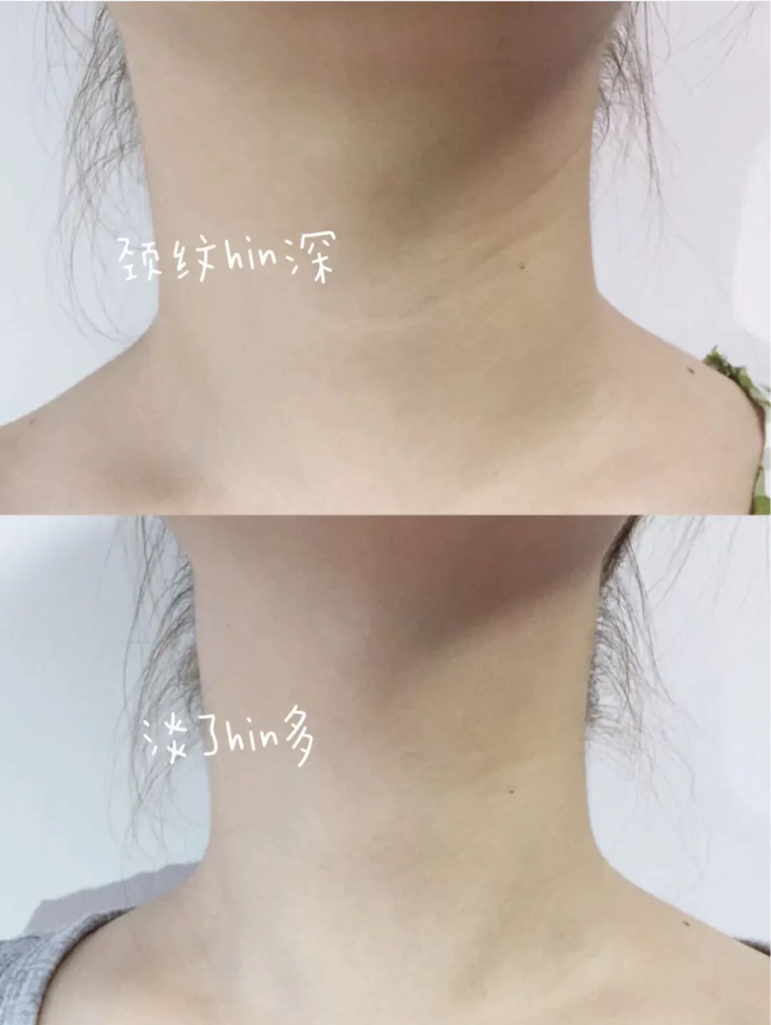 传说中的「颈纹小熨斗」重塑天鹅颈,收紧双下巴,还你小v脸