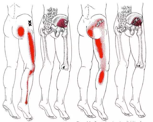 屁股疼痛总感觉像是火烧一样？经典名方帮您清热利湿，宣痹止痛