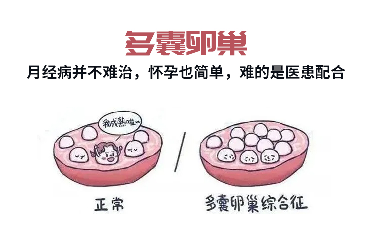 多囊卵巢能怀上孩子吗图片