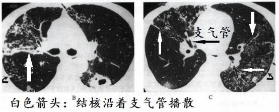 肺结核ct图片怎么看图片