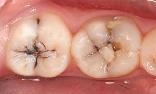 天医诊疗室|儿牙守护防线——窝沟封闭