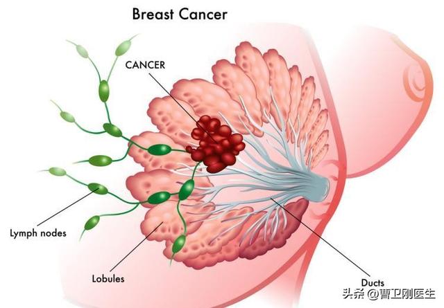 前哨淋巴結活檢術:提高乳腺癌患者,術後生活質量的證據