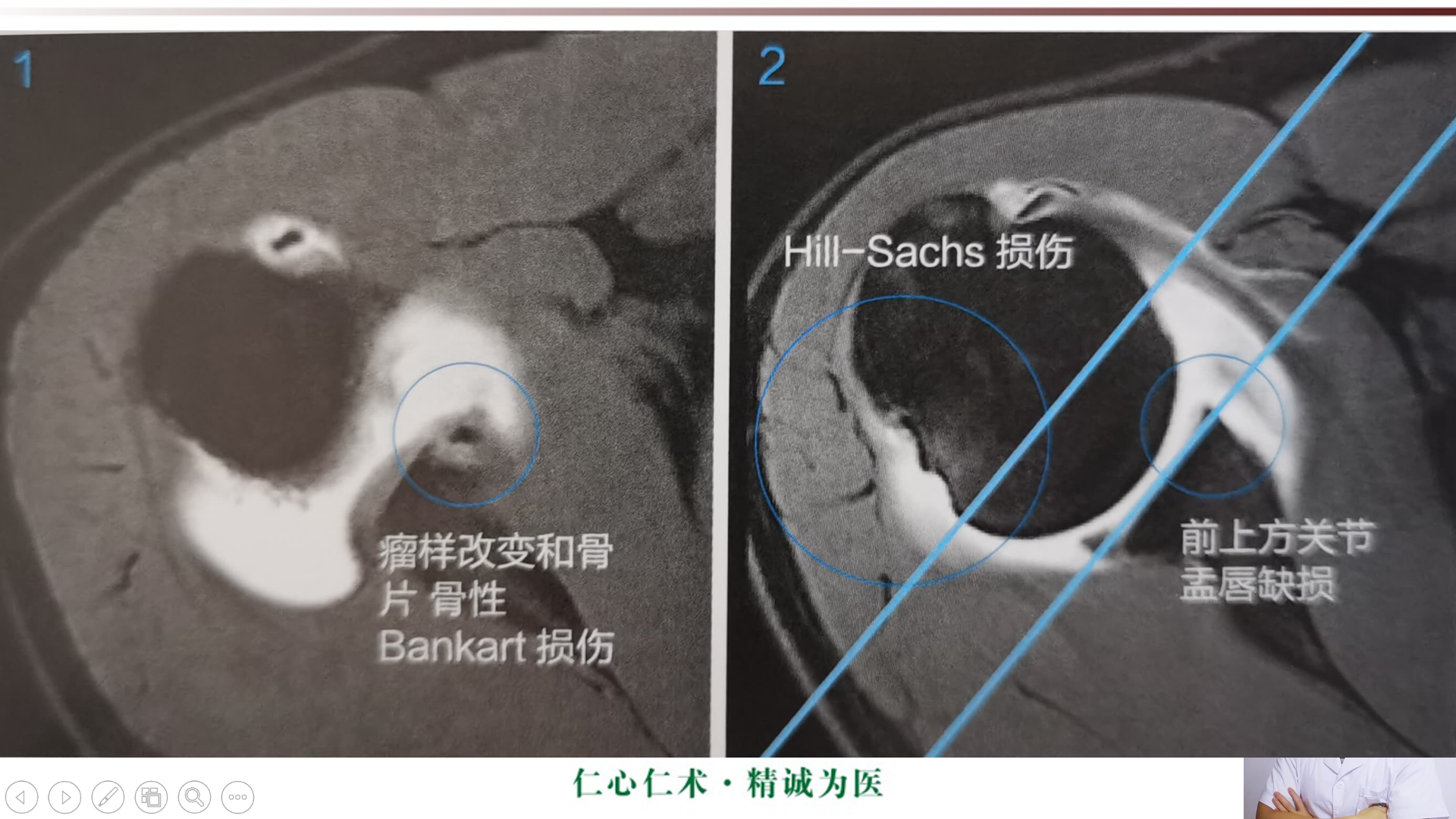 肩关节mri精品课程:肩关节盂唇损伤mri表现!