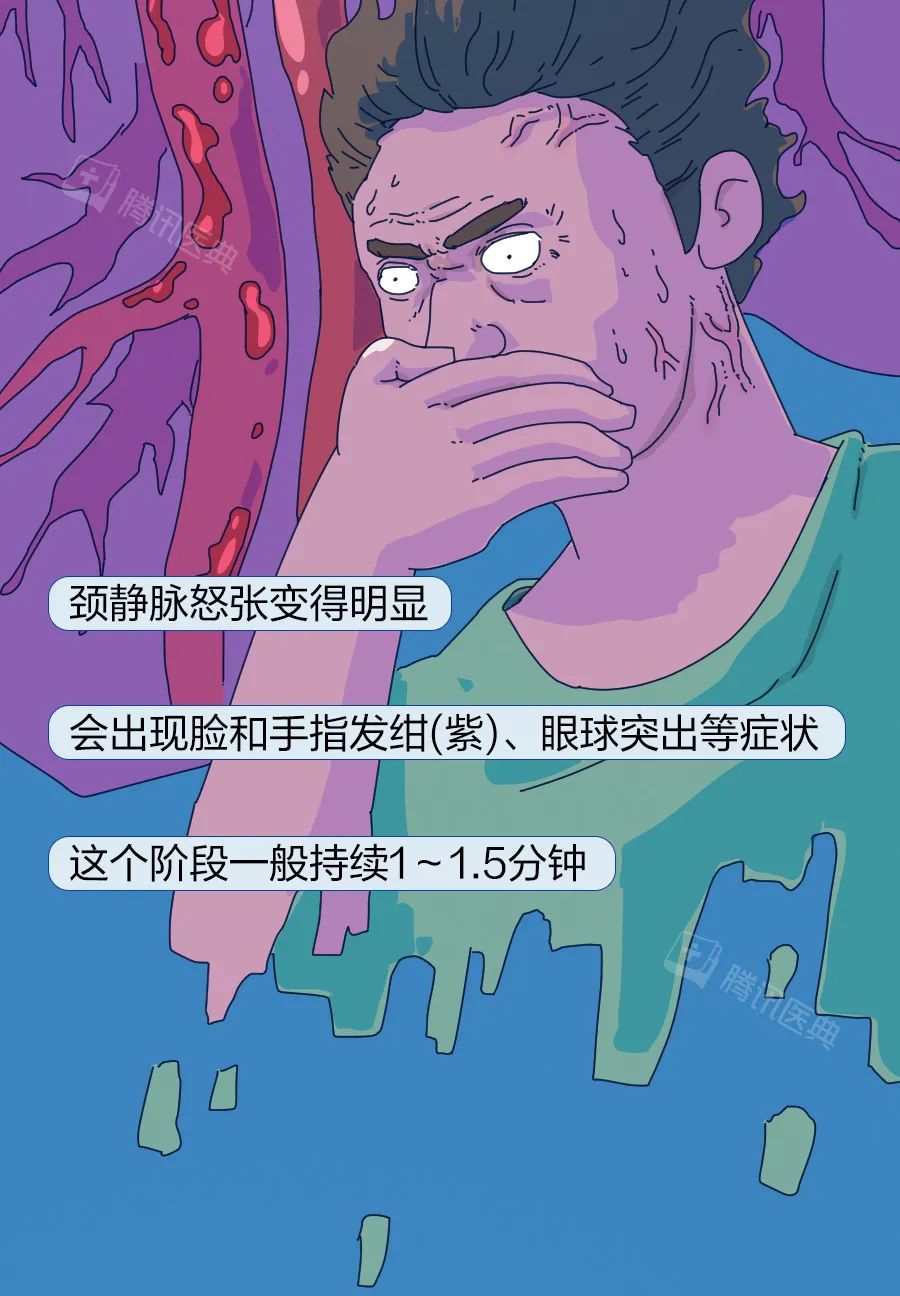 颈静脉怒张提示图片