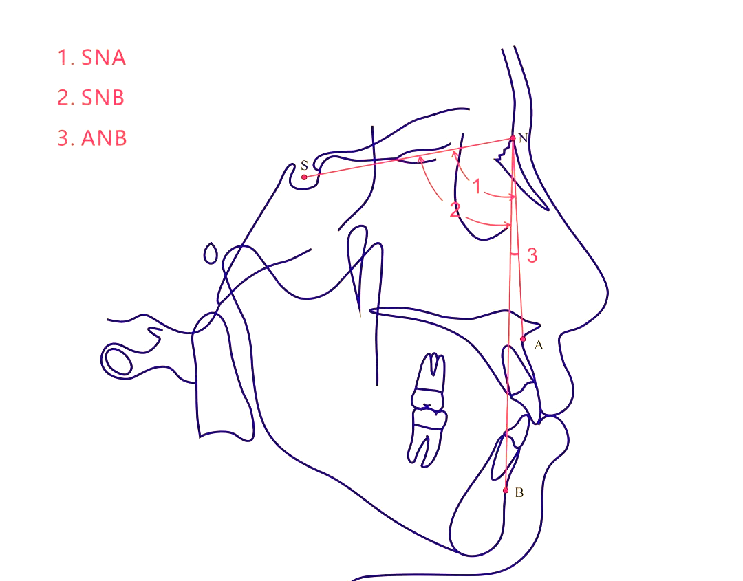 首先,我们来看看最常见的三个头影测量角度:sna,snb和anb,它们在正畸