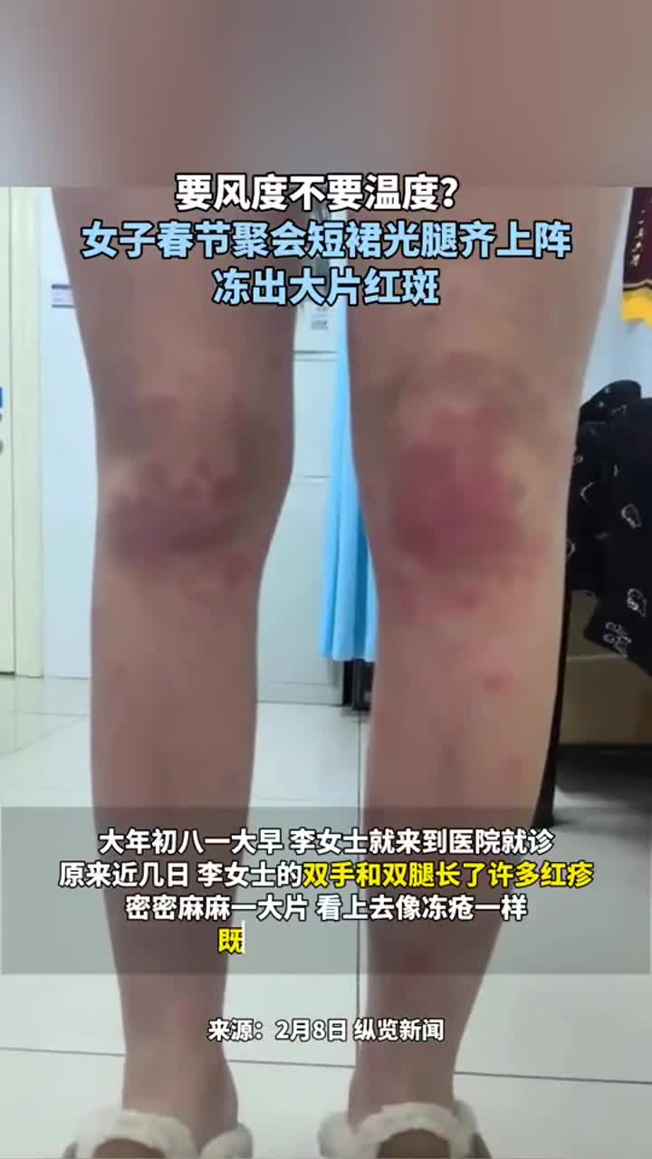 要风度不要温度?女子春节聚会短裙光腿齐上阵 冻出大片红斑