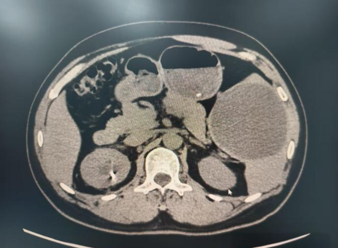 超声介入:脾囊肿治疗的微创新选择