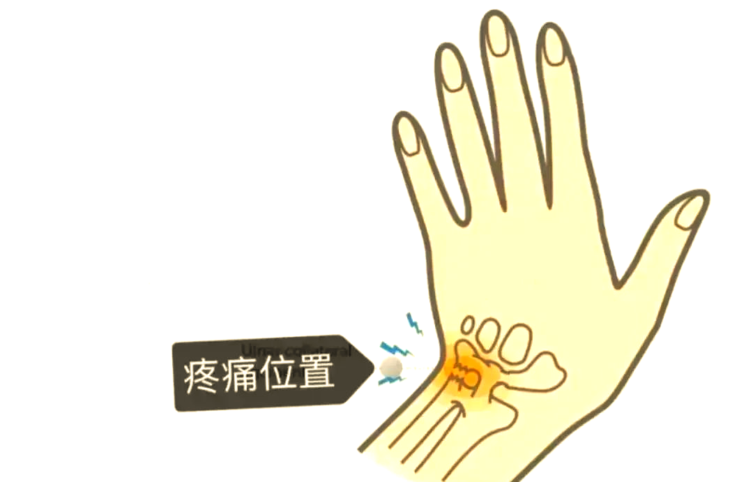 手腕疼痛难愈?可能是三角纤维软骨复合体损伤导致的