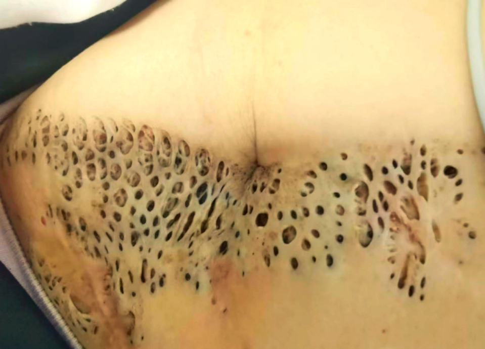 65岁患者黑头粉刺痣的诊断与治疗分析