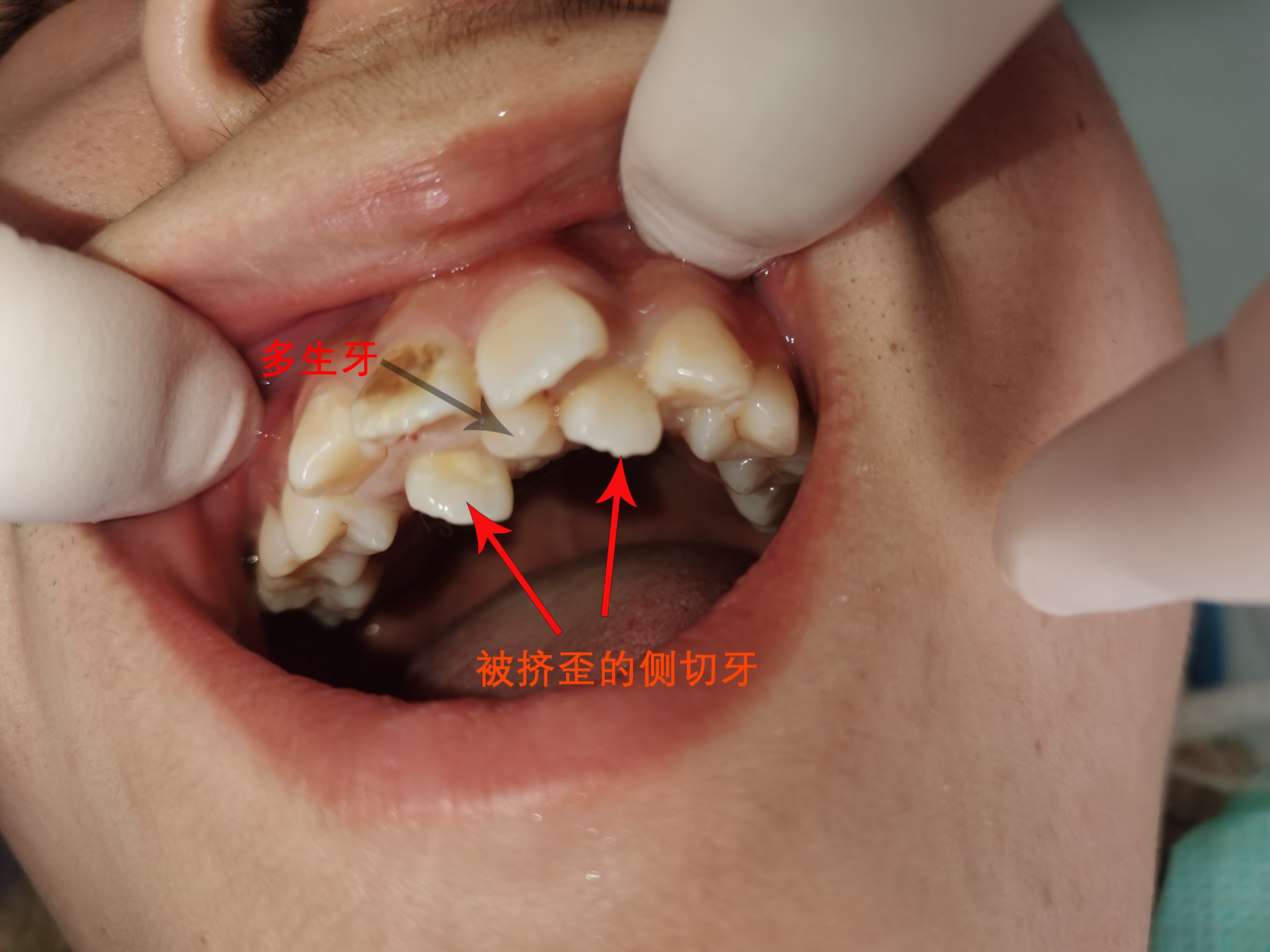 年轻小伙张开嘴牙齿似怪兽,多生牙问题不容小觑