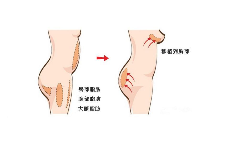 自体脂肪隆胸可以维持多久?