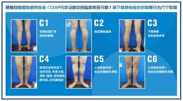 国产首款!惠及一亿人的“血管万能胶”进入临床