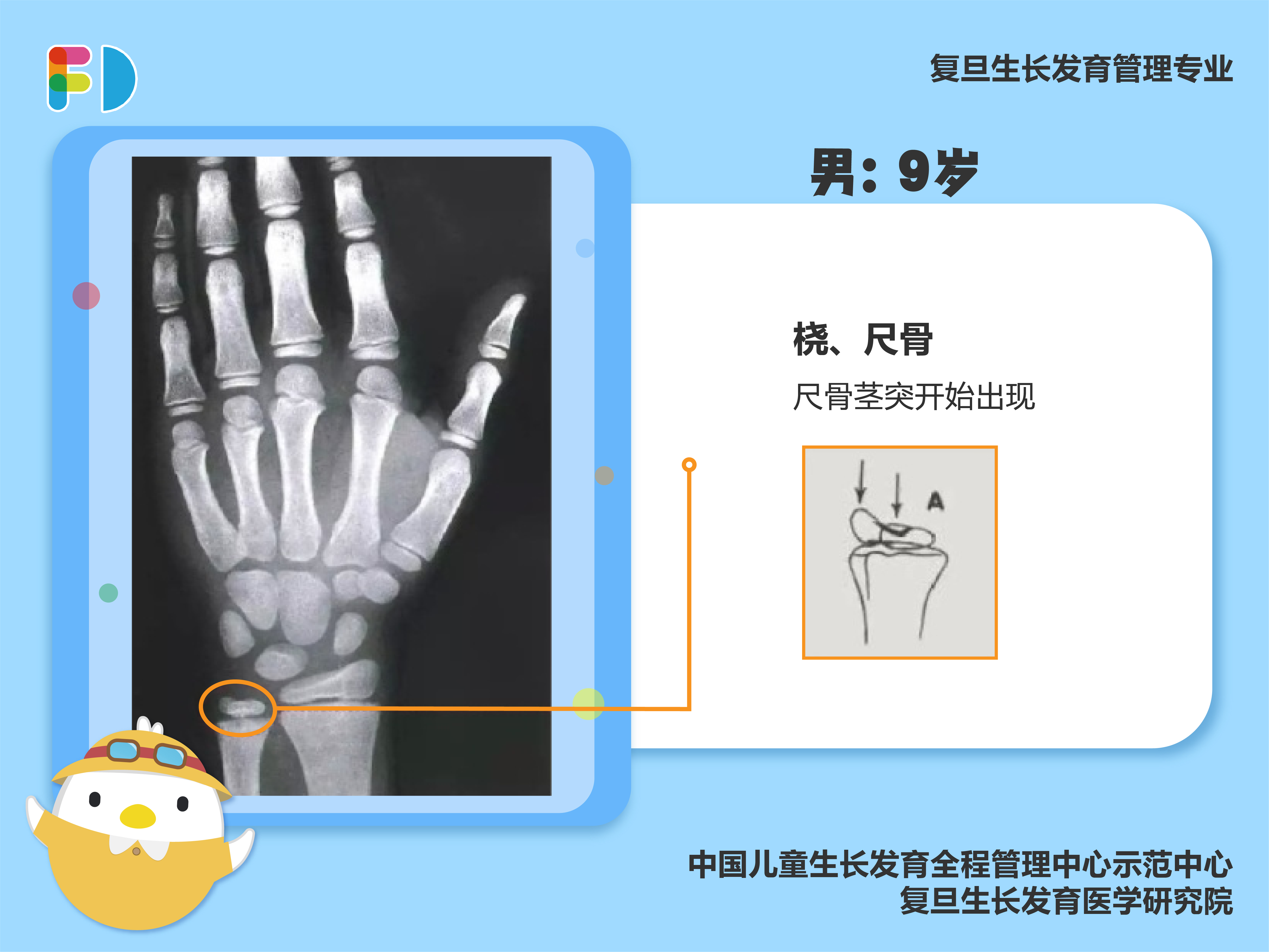 14岁骨龄片图片