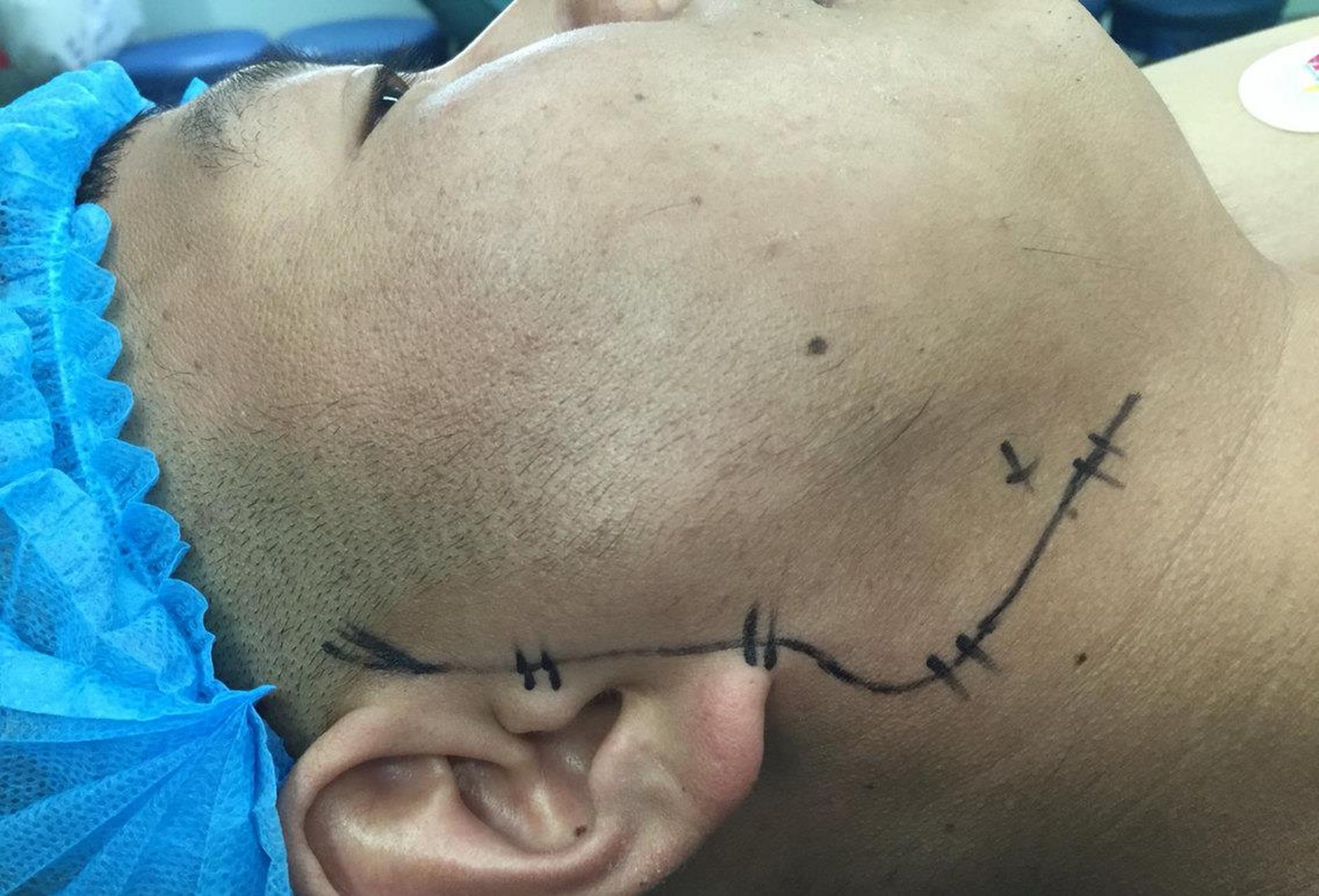 28岁男子,三个月前,右脸下方,靠近耳垂的部位出现一个肿块,摸上去硬硬