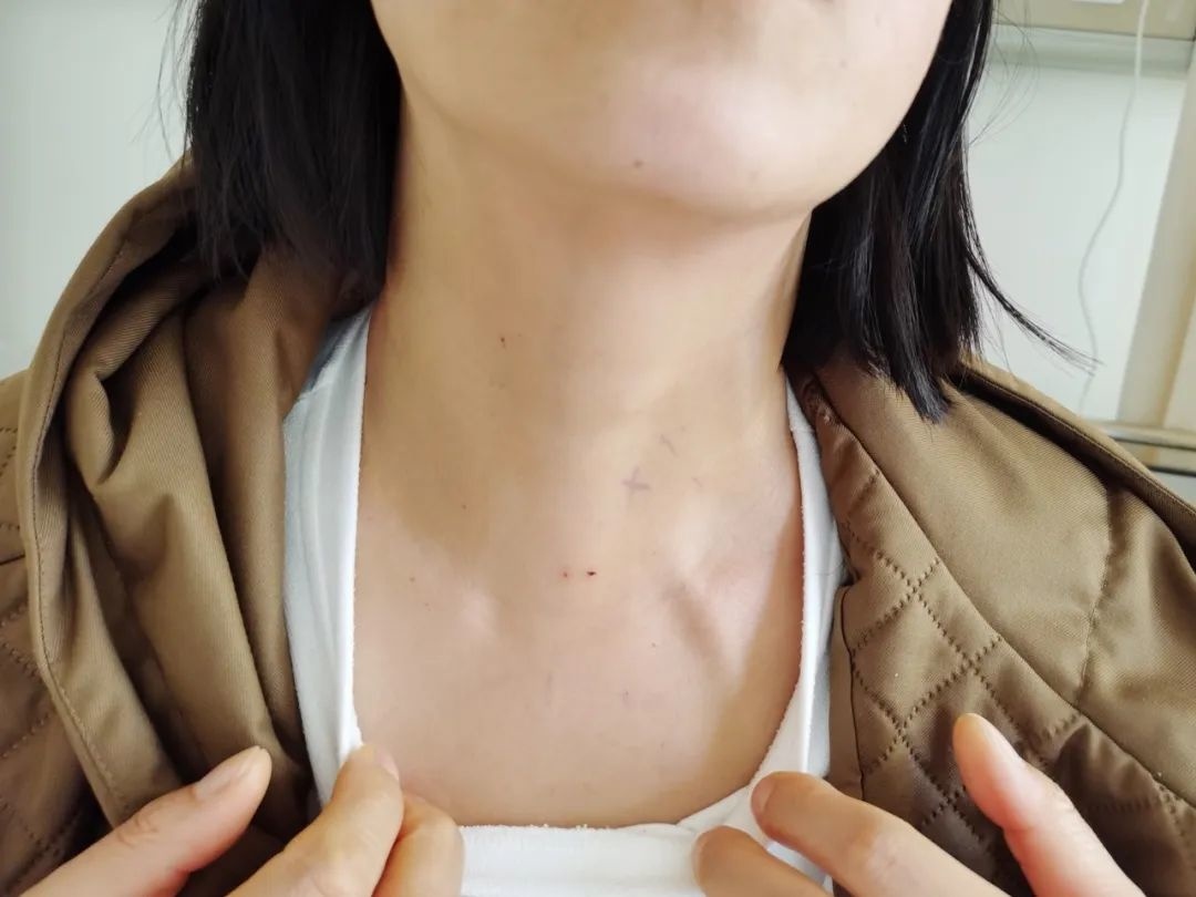 甲状腺癌也能"无痕"治疗!