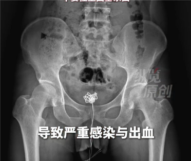 28岁男子好奇心太强：塞25厘米数据线进尿道拔不出