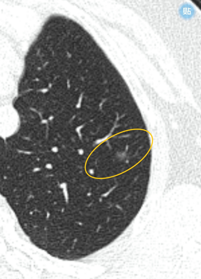 65岁双肺多发磨玻璃结节介于原位到微浸润腺癌之,别急,可以等等
