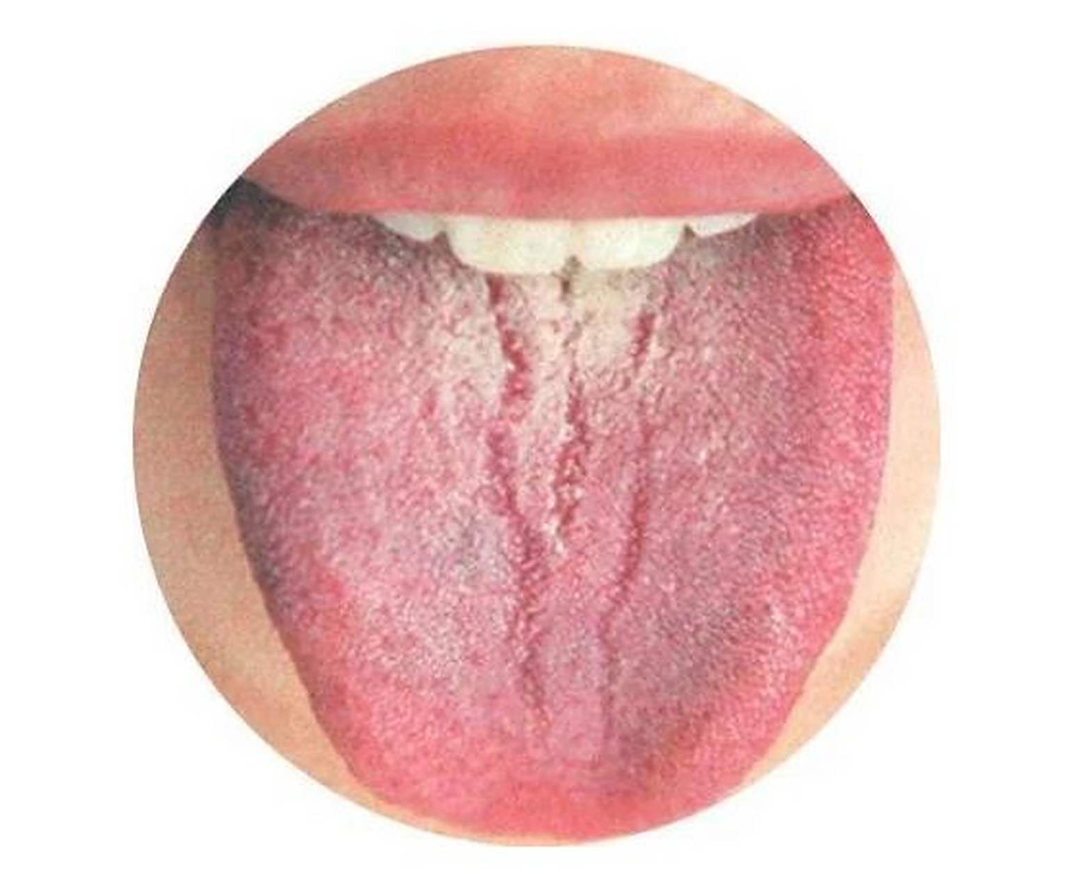 1,痰湿阻滞——舌苔厚腻,有裂纹 病机:痰湿阻滞中焦脾胃,导致脾运化