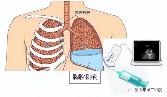 邯鄲市第二醫院胸腔穿刺置管閉式引流術解除患者病痛