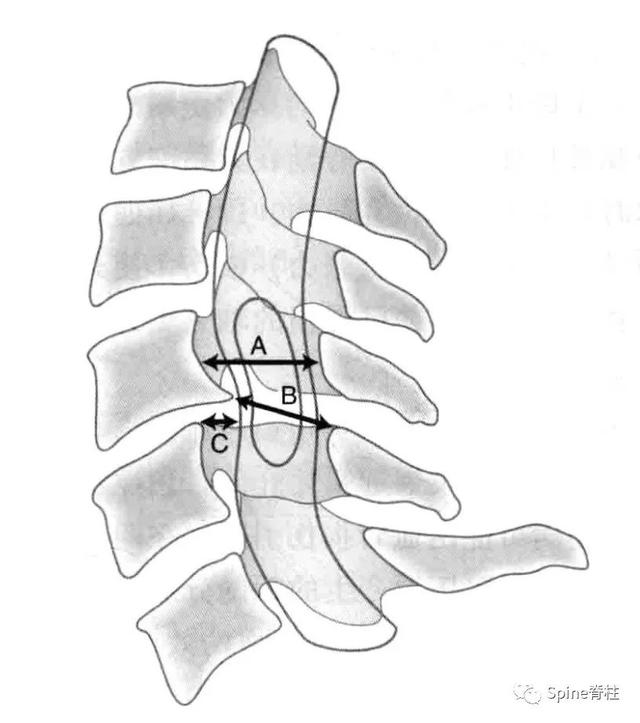 回顾:颈椎病 cervical spondylosis