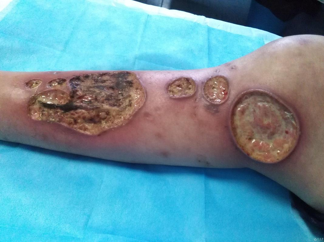 蛆虫清创与高压氧治疗:坏疽性脓皮病的突破性疗法探索