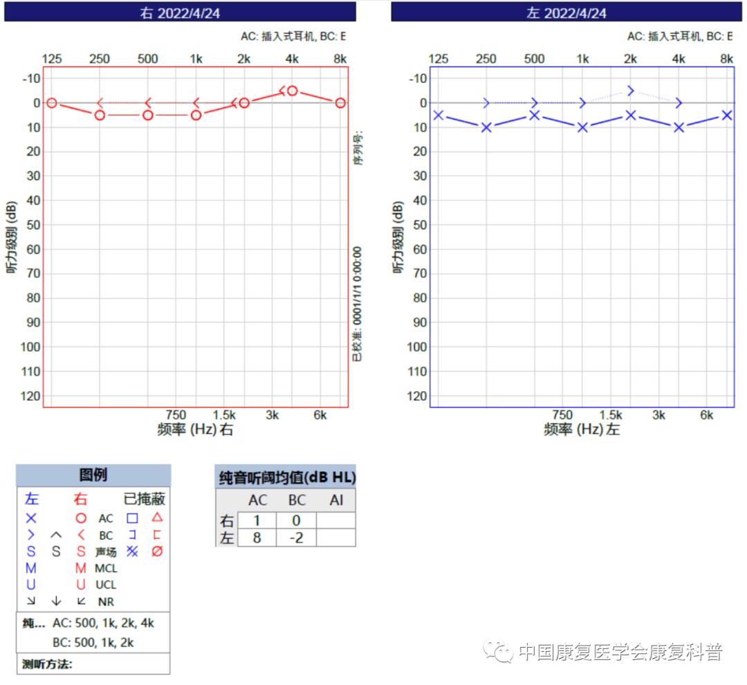 听力检测中的金标准——纯音测听