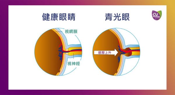 研究表明:有高眼压遗传倾向者 多喝咖啡或增青光眼风险