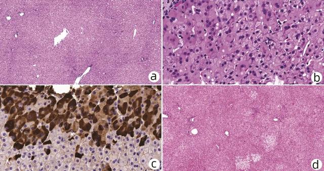 专家论坛｜赵新颜：“基本正常肝组织”的病理鉴别诊断思路